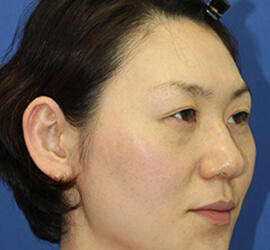 30代女性の3Dリポアイリフト  Before 症例写真