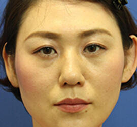 30代女性の3Dリポアイリフト Before 症例写真