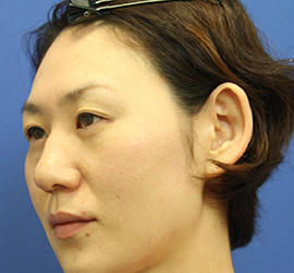 30代女性の3Dリポアイリフト  Before 症例写真