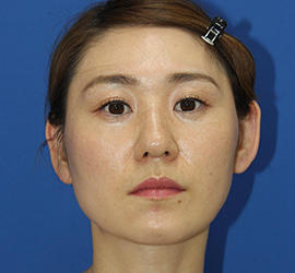 30代女性のバッカルファット除去 After 症例写真