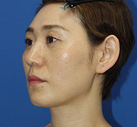 30代女性のシワ・たるみ After 症例写真