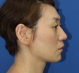 30代女性のバッカルファット除去 After 症例写真