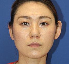 30代女性のバッカルファット除去 Before 症例写真