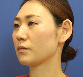 30代女性のシワ・たるみ Before 症例写真