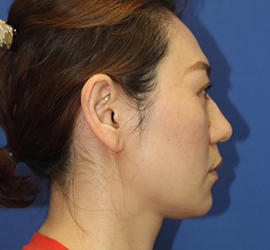 30代女性のバッカルファット除去 Before 症例写真