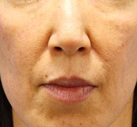 40代女性のヒアルロン酸注射（ゴルゴライン） After 症例写真