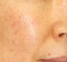 40代女性のヒアルロン酸注射 After 症例写真