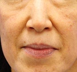 40代女性のヒアルロン酸注射（ゴルゴライン） Before 症例写真
