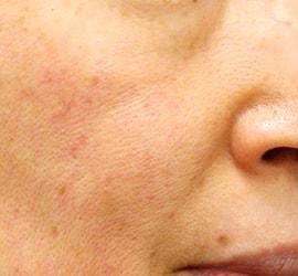 40代女性のヒアルロン酸注射 Before 症例写真