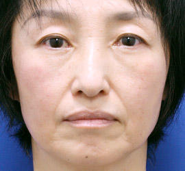 50代女性の目の下の脱脂 After 症例写真