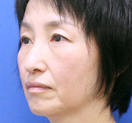 50代女性の目の下の脱脂  After 症例写真