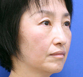 50代女性の目の下の脱脂  After 症例写真