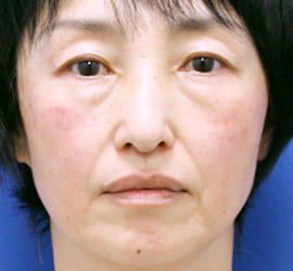 50代女性の目の下の脱脂 Before 症例写真