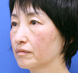 50代女性の目の下の脱脂  Before 症例写真