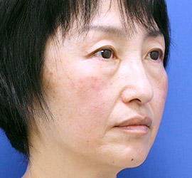 50代女性の目の下の脱脂  Before 症例写真