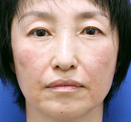 50代女性のヒアルロン酸注射  After 症例写真