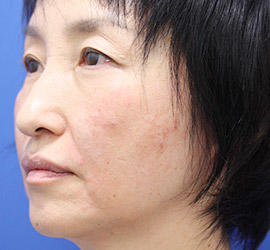 50代女性のヒアルロン酸注射  After 症例写真