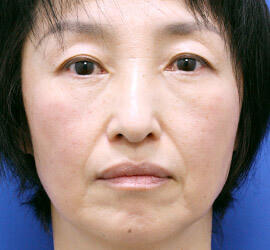 50代女性のヒアルロン酸注射  Before 症例写真