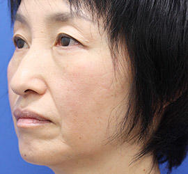 50代女性のヒアルロン酸注射  Before 症例写真