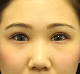 10代女性の二重整形・目元の整形 After 症例写真