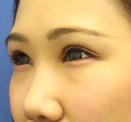 10代女性の全切開二重まぶた法 After 症例写真