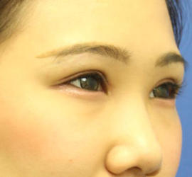 10代女性の全切開二重まぶた法 After 症例写真