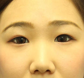 10代女性の二重整形・目元の整形 Before 症例写真
