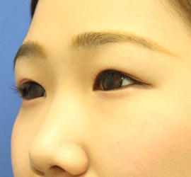10代女性の全切開二重まぶた法 Before 症例写真