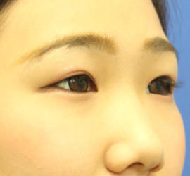 10代女性の全切開二重まぶた法 Before 症例写真