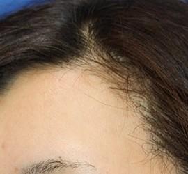 20代女性のメディカル美肌セレクト After 症例写真