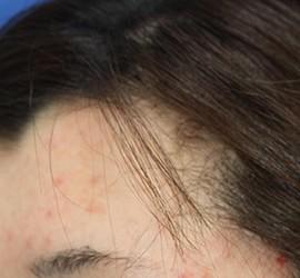 20代女性のメディカル美肌セレクト Before 症例写真