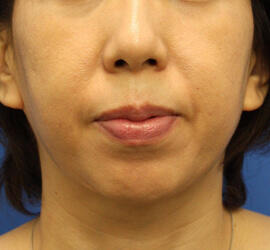 40代女性のサーマクール After 症例写真