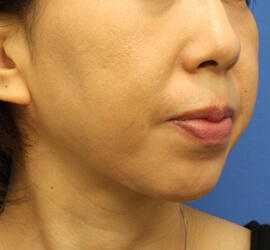 40代女性のサーマクール After 症例写真