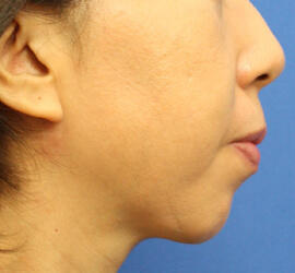 40代女性のサーマクール After 症例写真