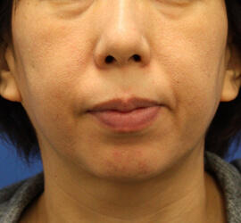 40代女性のサーマクール Before 症例写真