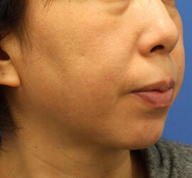 40代女性のサーマクール Before 症例写真