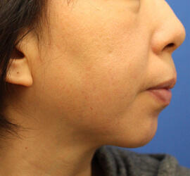 40代女性のサーマクール Before 症例写真