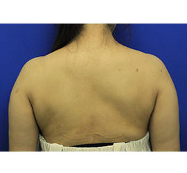 50代女性のボトックス（美肩・肩こり解消） After 症例写真