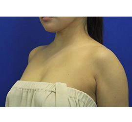 50代女性のボトックス（美肩・肩こり解消） After 症例写真