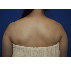 50代女性のボトックス（美肩・肩こり解消） Before 症例写真