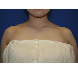 50代女性のボトックス（美肩・肩こり解消） Before 症例写真