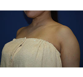 50代女性のボトックス（美肩・肩こり解消） Before 症例写真