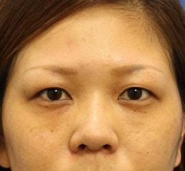 20代女性の目の下の脱脂 After 症例写真