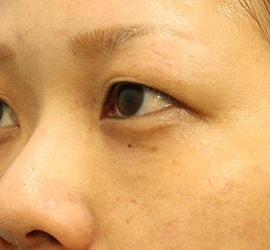 20代女性の目の下の脱脂  After 症例写真