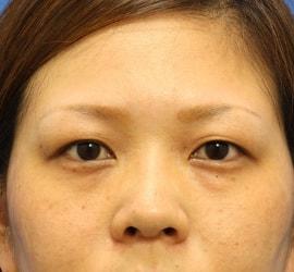 20代女性の目の下の脱脂 Before 症例写真