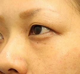 20代女性の目の下の脱脂  Before 症例写真