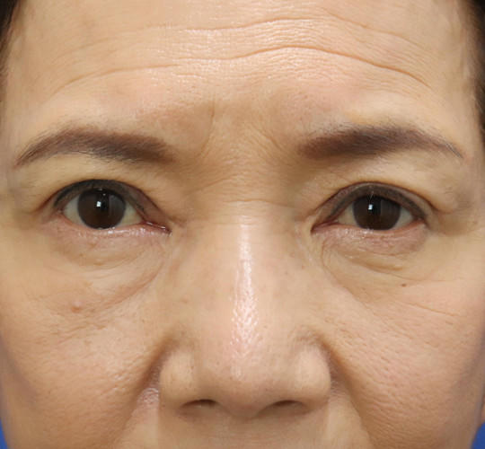 60代女性の眼瞼下垂 After 症例写真