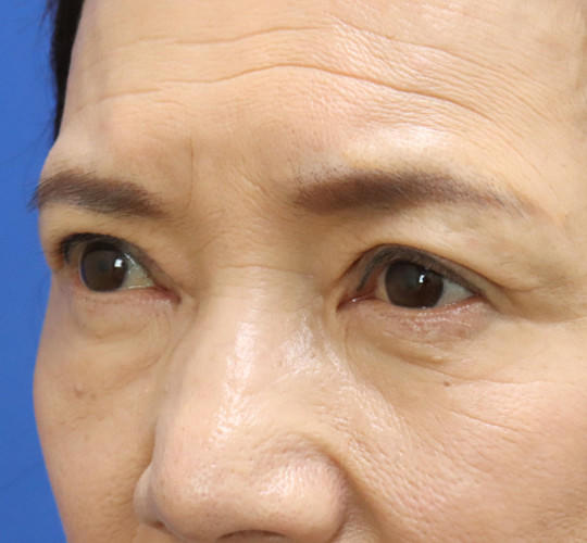 60代女性の眼瞼下垂 After 症例写真