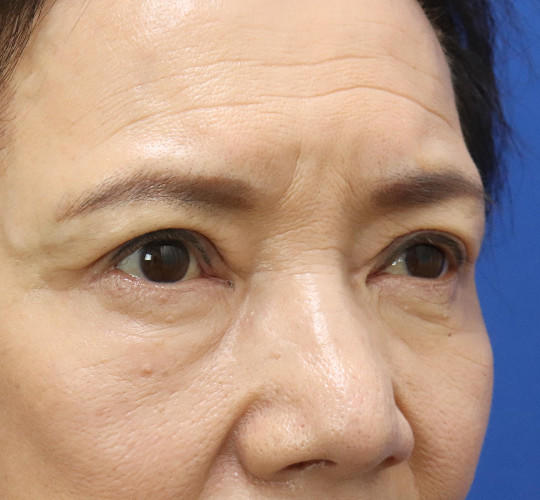 60代女性の眼瞼下垂 After 症例写真