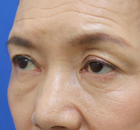 60代女性の眼瞼下垂 Before 症例写真
